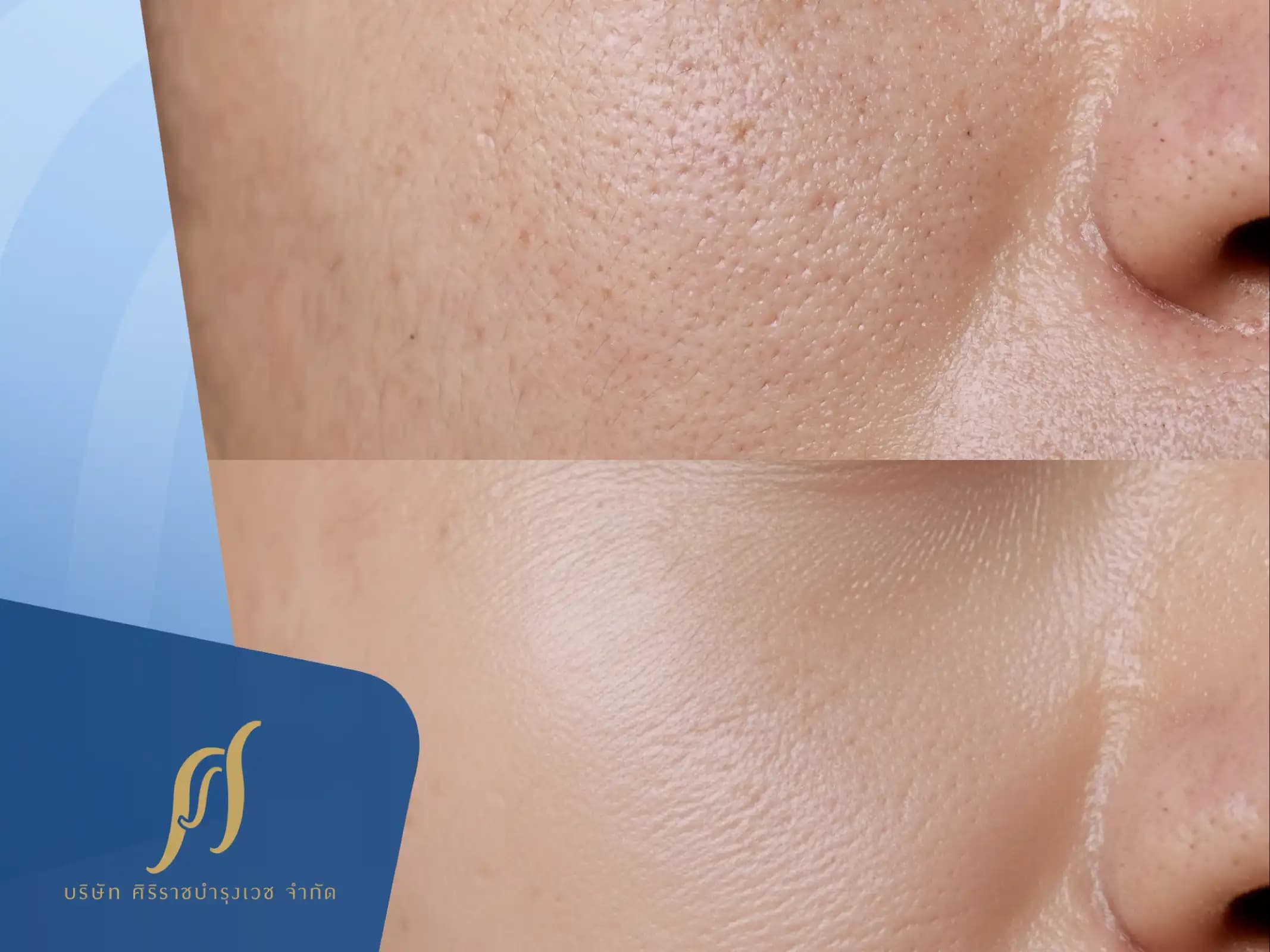 กระชับรูขุมขนบนใบหน้าทำอย่างไร ?  รวม 6 วิธีให้ผิวดูเรียบเนียนขึ้น