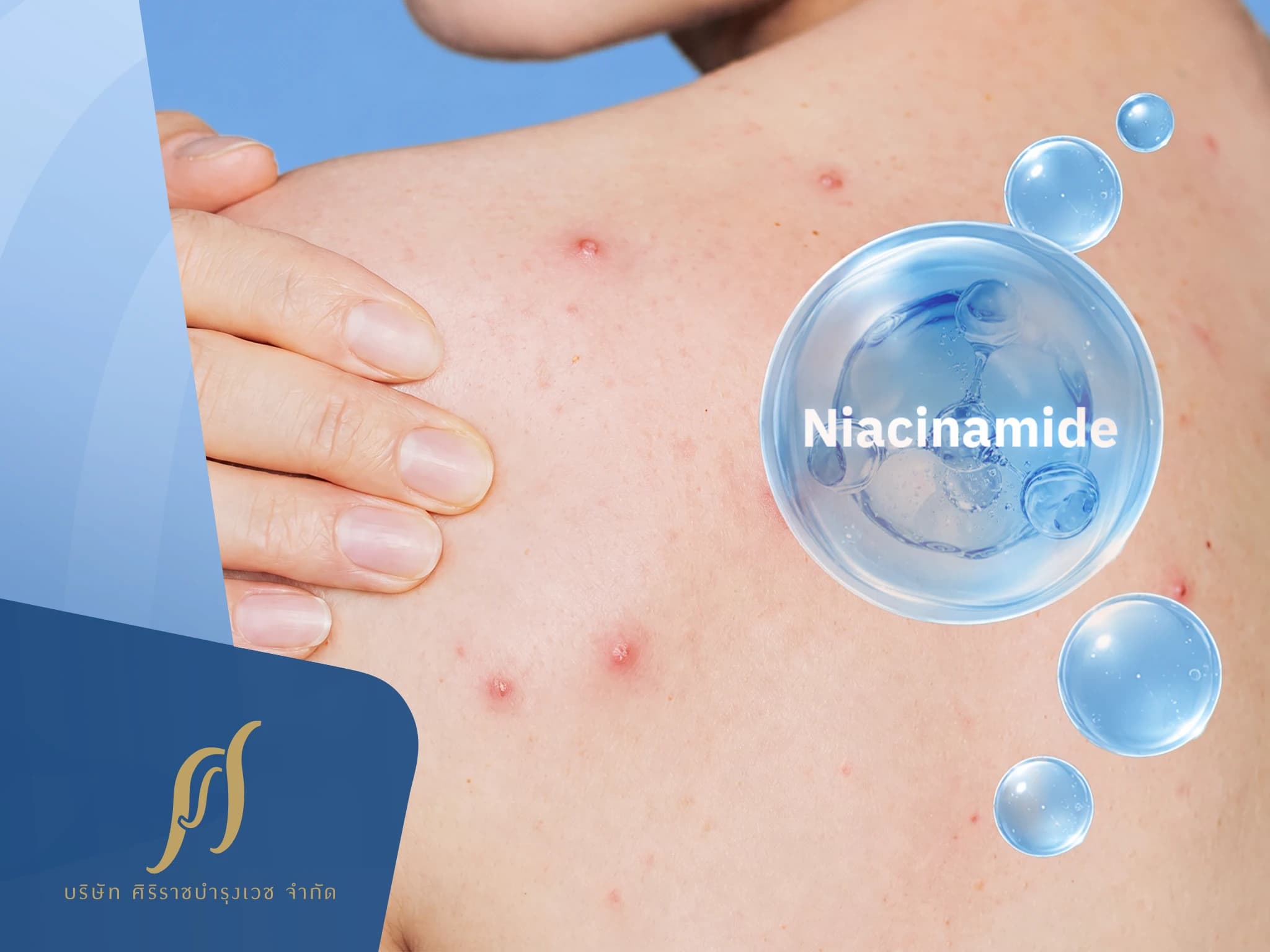 Niacinamide หรือวิตามิน B3 ช่วยแก้ปัญหาสิวที่ตัวได้จริงไหม
